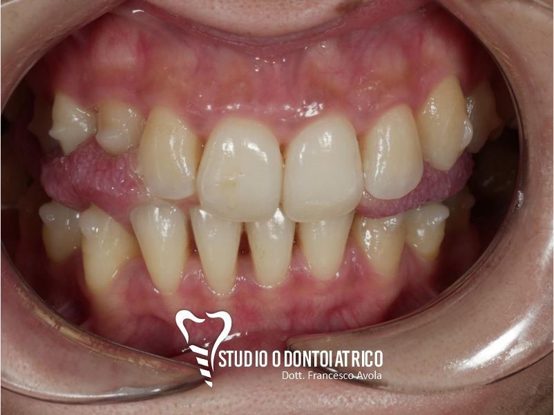 Dopo del trattamento odontoiatrico