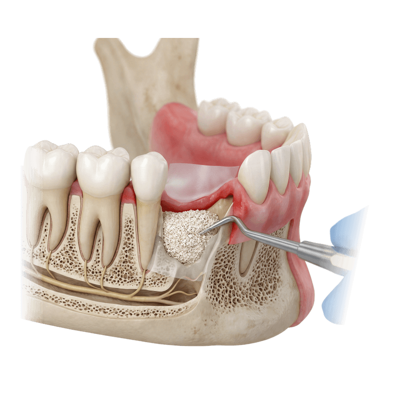 Preservazione alveolare - Studio odontoiatrico Dott.ri Avola