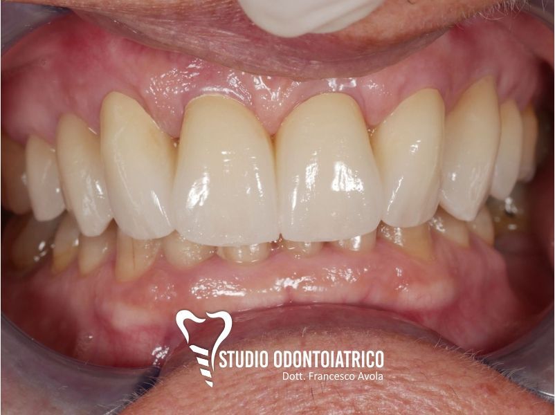 Dopo del trattamento odontoiatrico