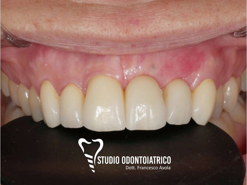 Dopo del trattamento odontoiatrico