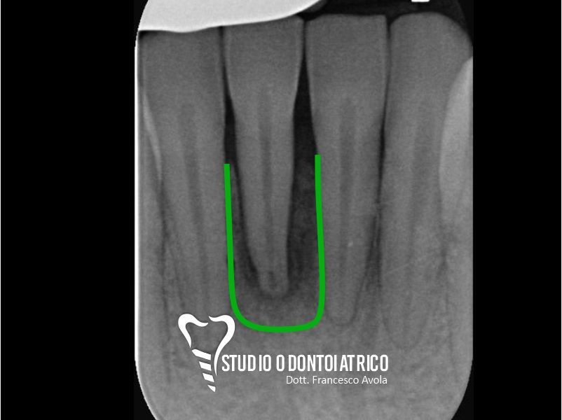 Dopo del trattamento odontoiatrico