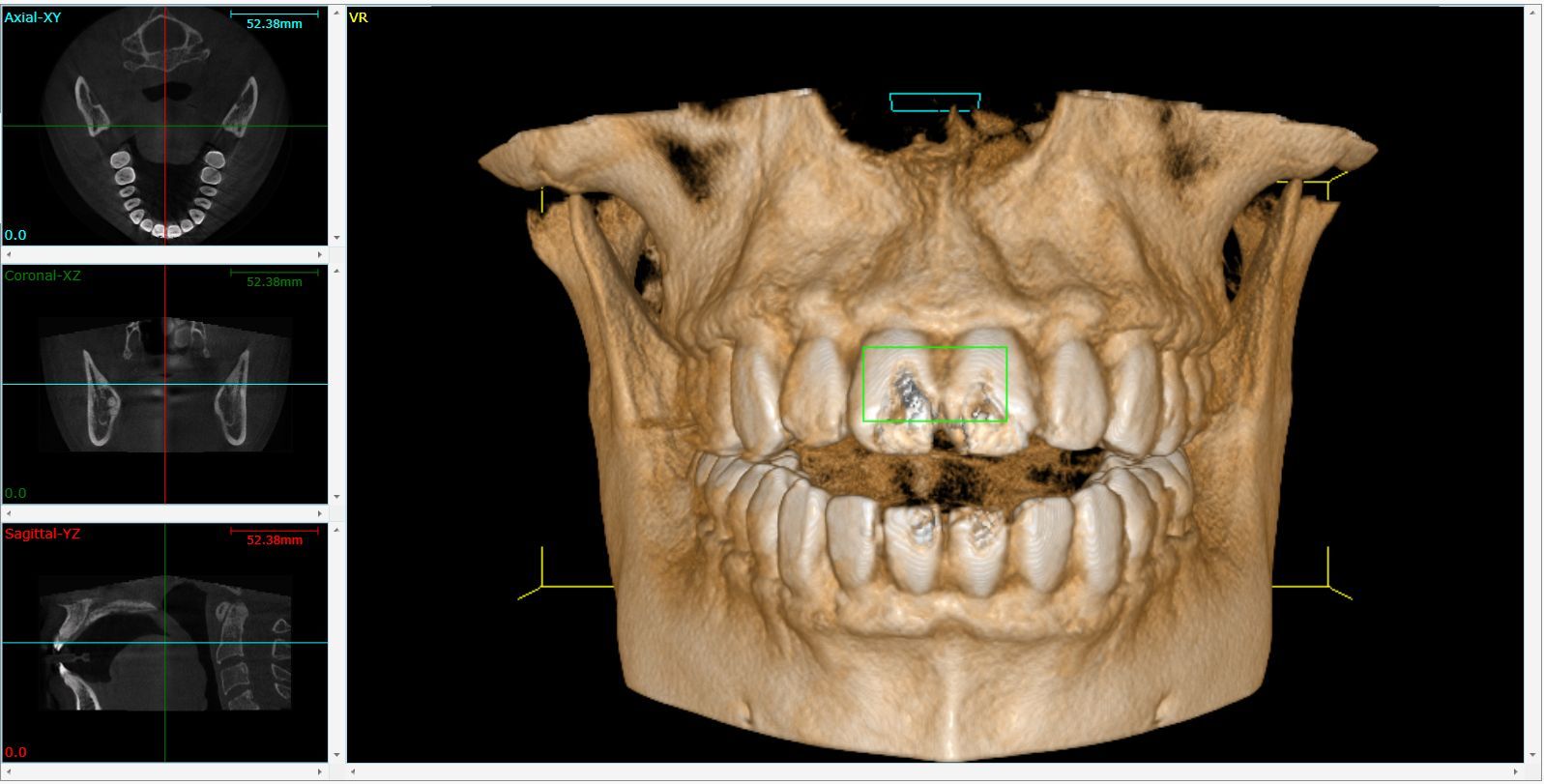 La CBCT (tac) in odontoiatria