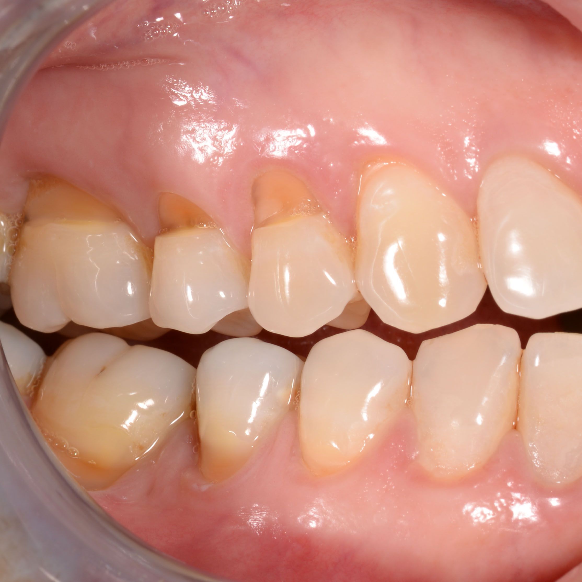 Perchè ho i denti sensibili?