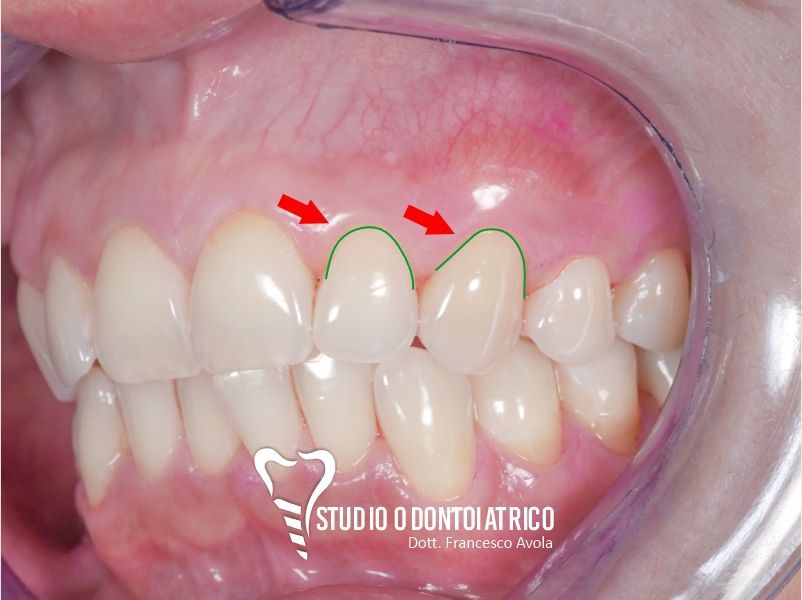 Dopo del trattamento odontoiatrico