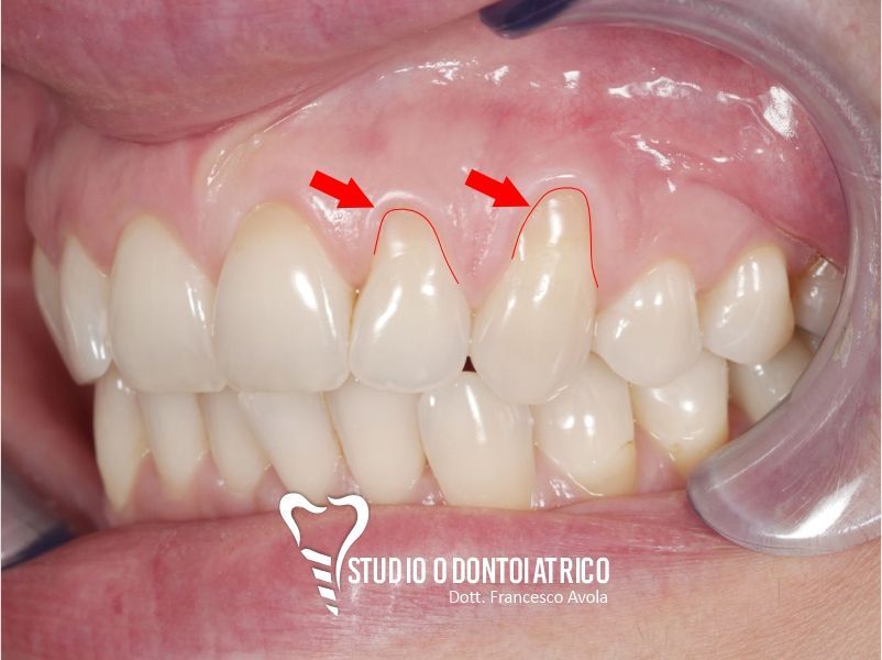 Prima del trattamento odontoiatrico