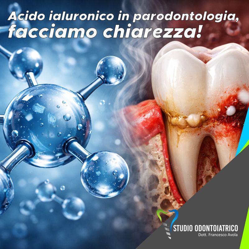 Acido ialuronico in parodontologia, facciamo chiarezza