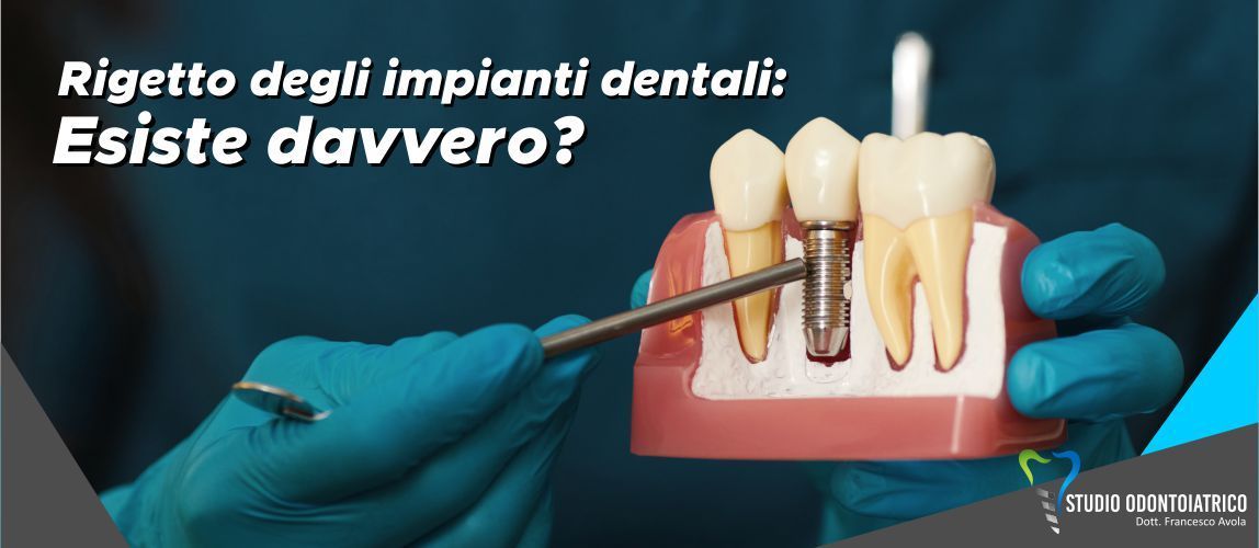 Rigetto degli impianti dentali: Esiste davvero?