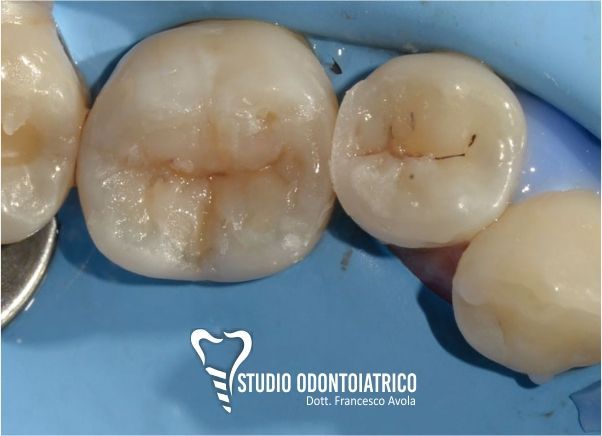 Dopo del trattamento odontoiatrico