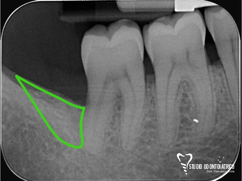 Dopo del trattamento odontoiatrico