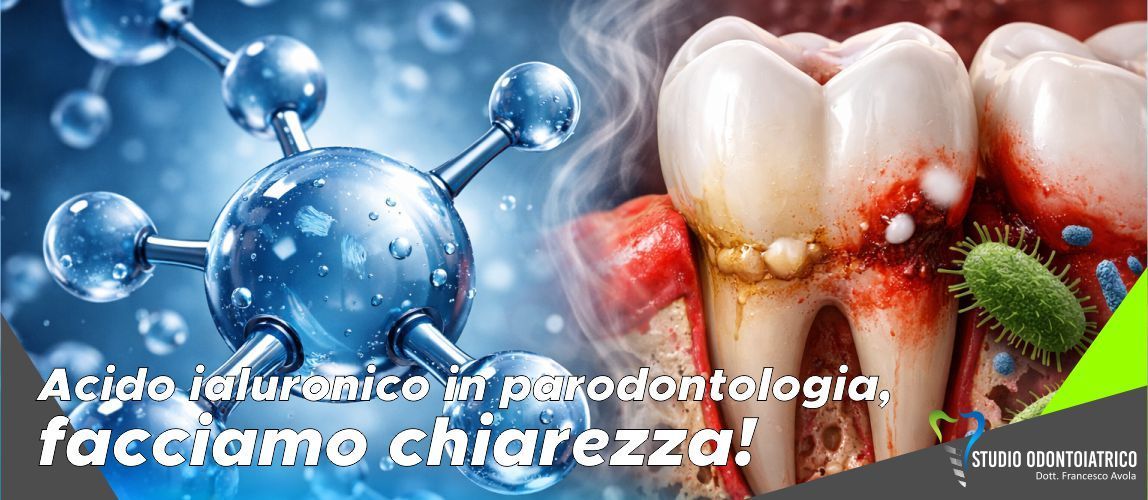 Acido ialuronico in parodontologia, facciamo chiarezza