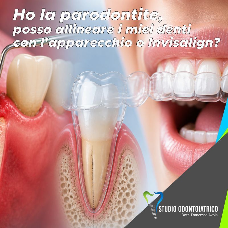 Ho la parodontite, posso allineare i miei denti con l'apparecchio o Invisalign?