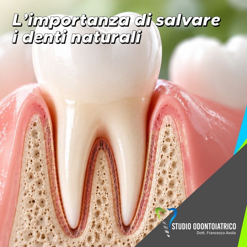 L'importanza di salvare i denti naturali