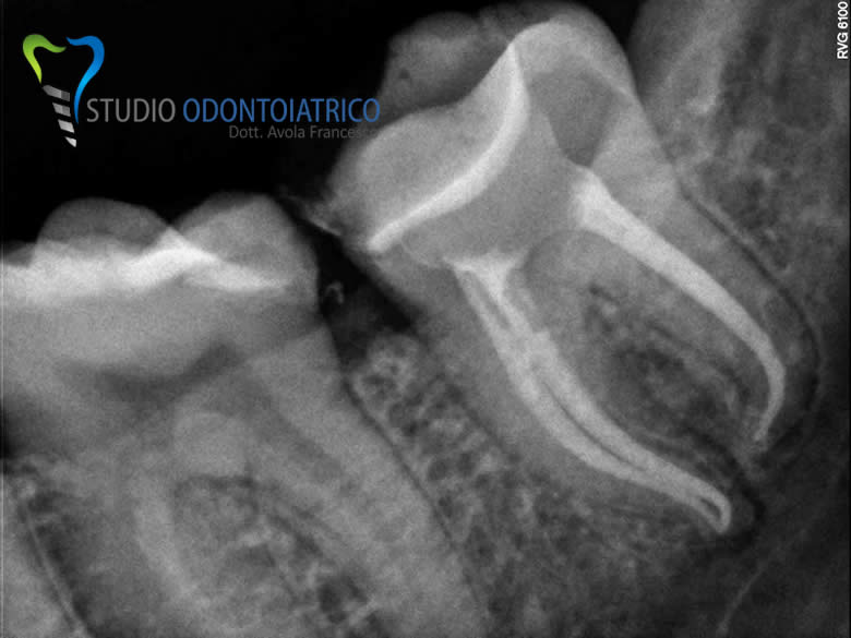 Endodonzia