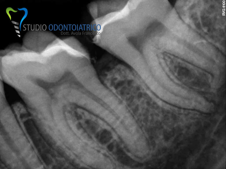 Endodonzia