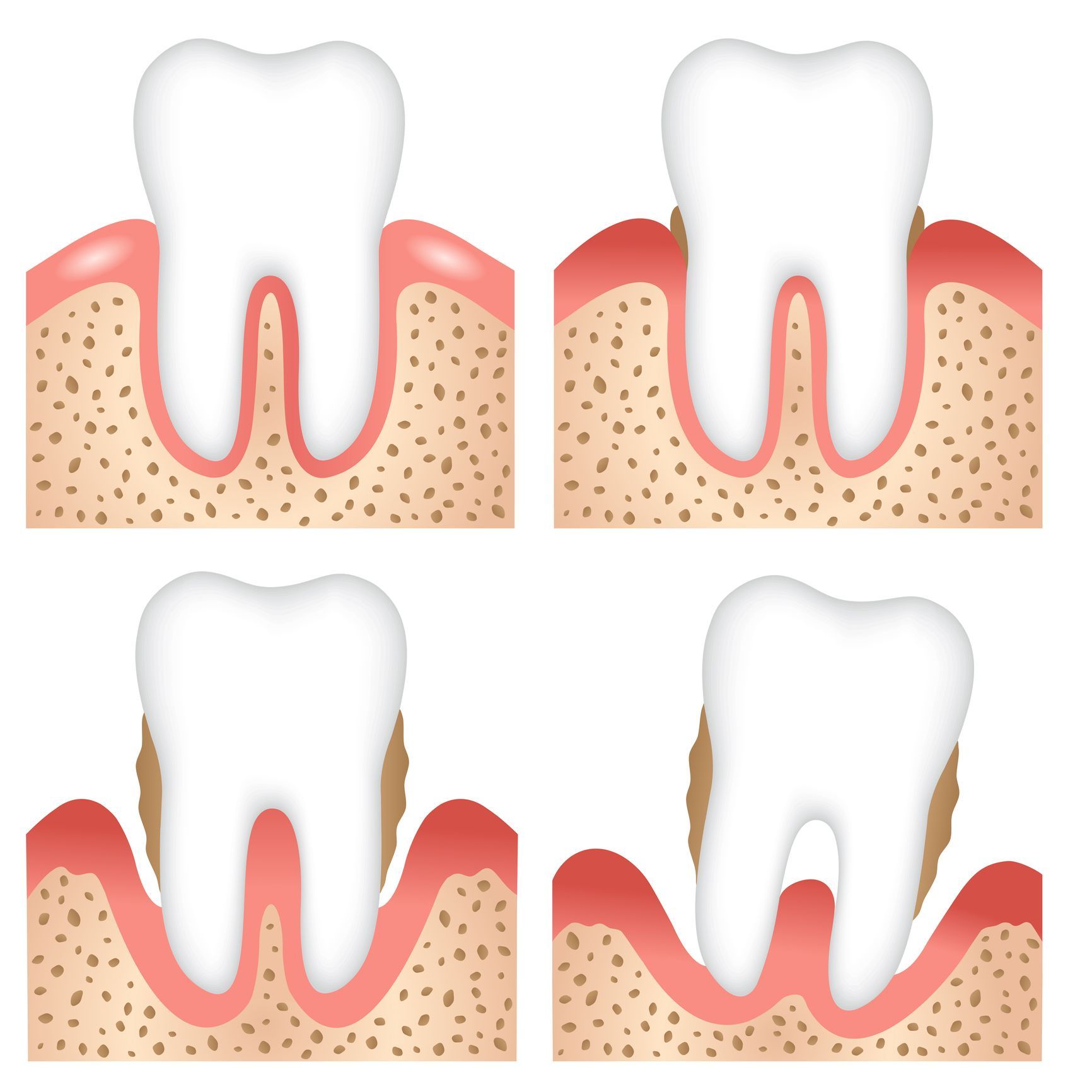 Capire la Parodontite per prevenire la perdita dei denti