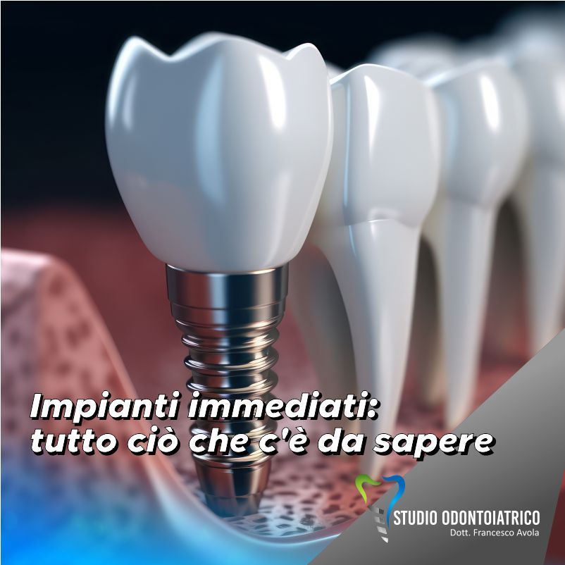 Impianti immediati: tutto ciò che c'è da sapere