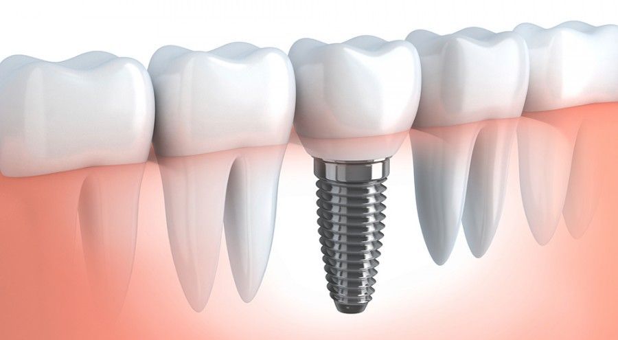 Impianti dentali: tutto ciò che bisogna sapere