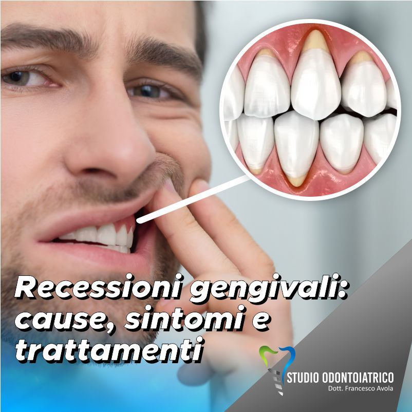 Recessioni gengivali: cause, sintomi e trattamenti nel nostro studio odontoiatrico di Palermo