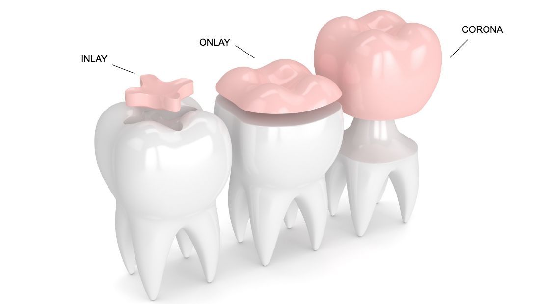 Intarsi e Corone dentali