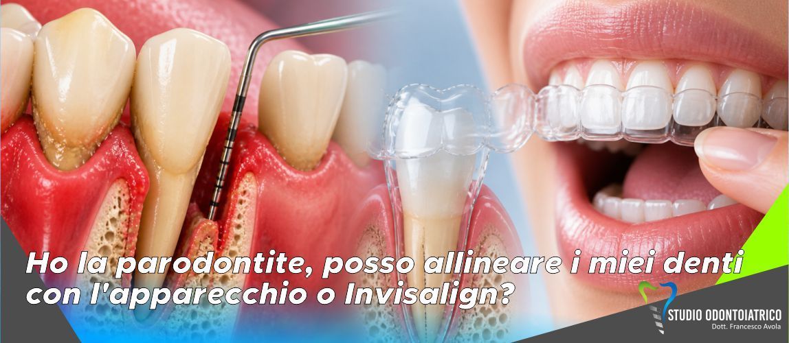 Ho la parodontite, posso allineare i miei denti con l'apparecchio o Invisalign?