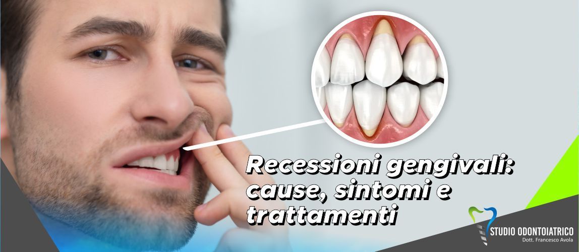 Recessioni gengivali: cause, sintomi e trattamenti nel nostro studio odontoiatrico di Palermo