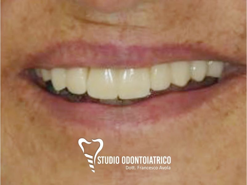 Dopo del trattamento odontoiatrico