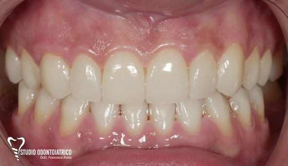 Implantologia dentale