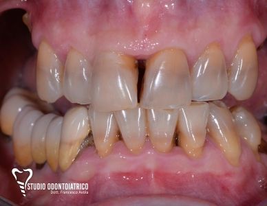 Implantologia dentale