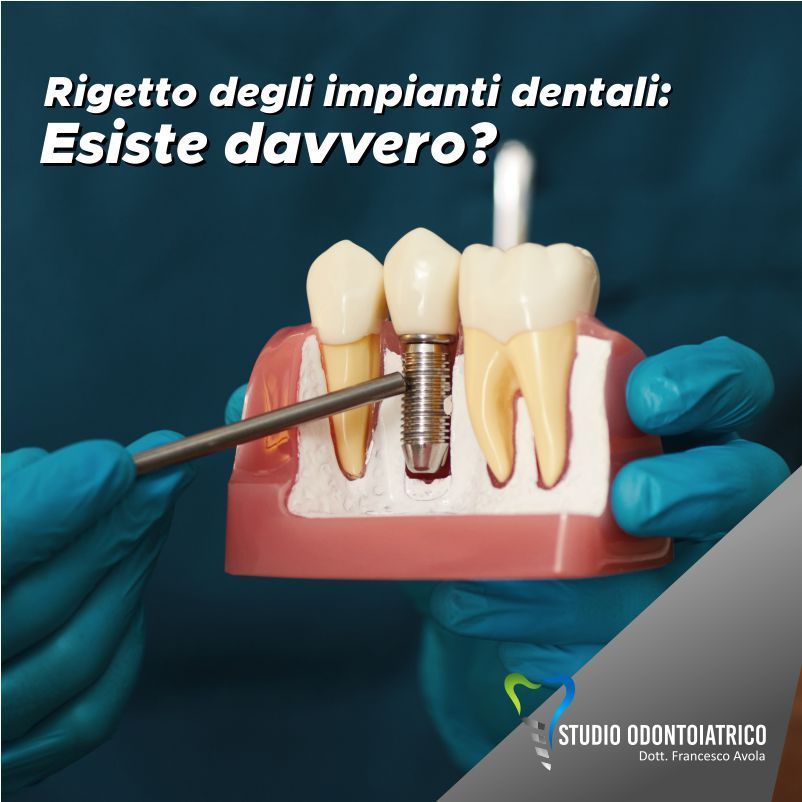 Rigetto degli impianti dentali: Esiste davvero?