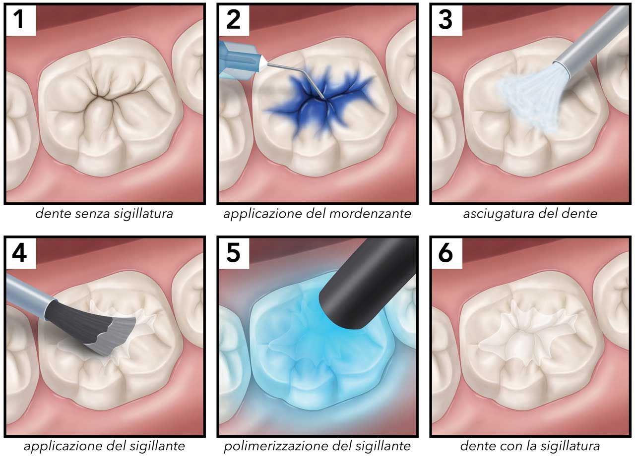 Sigillature dentali