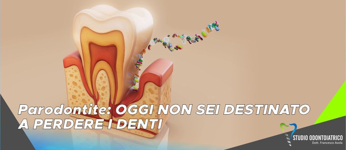 Parodontite: OGGI NON SEI DESTINATO A PERDERE I DENTI