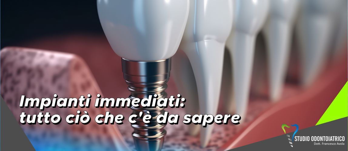 Impianti immediati: tutto ciò che c'è da sapere