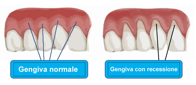 Differenza tra gengive sane e gengive con recessione