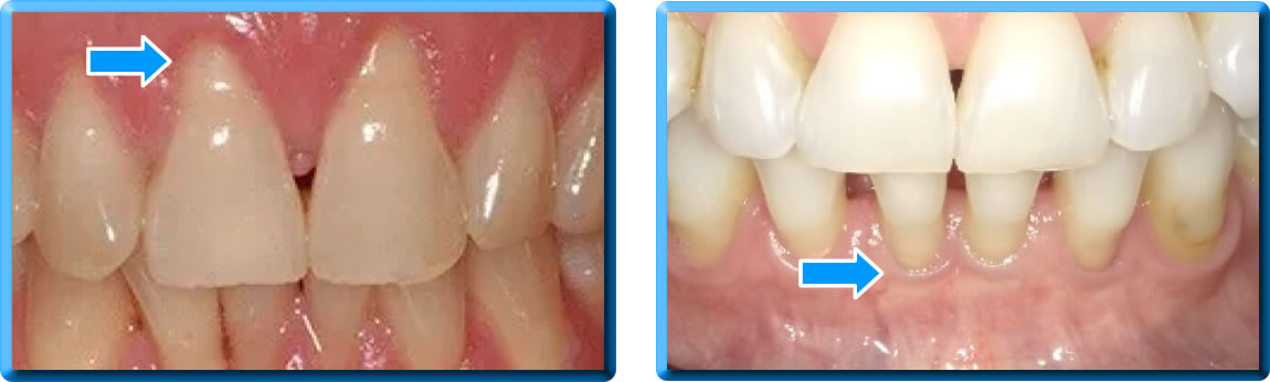 Dentista a Palermo effettua interventi per sanare la recessione gengivale