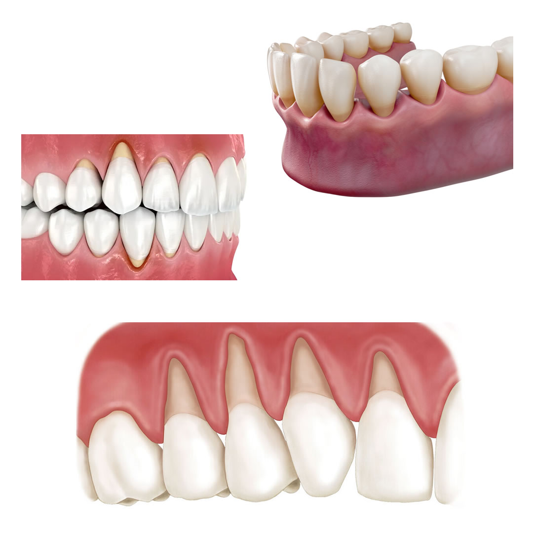 Esempi di recessione gengivale - dentista a Palermo